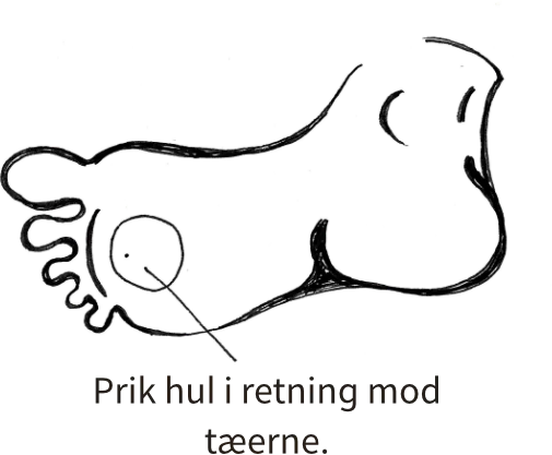 Vabel på hælen